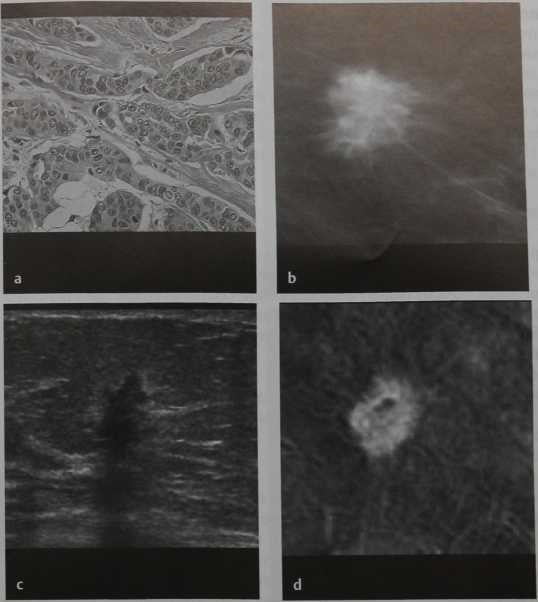 Снимки МРТ и КТ. Инвазивный протоковый рак