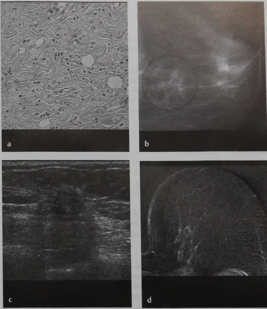 Снимки МРТ и КТ. Инвазивный дольковый рак, диффузная форма
