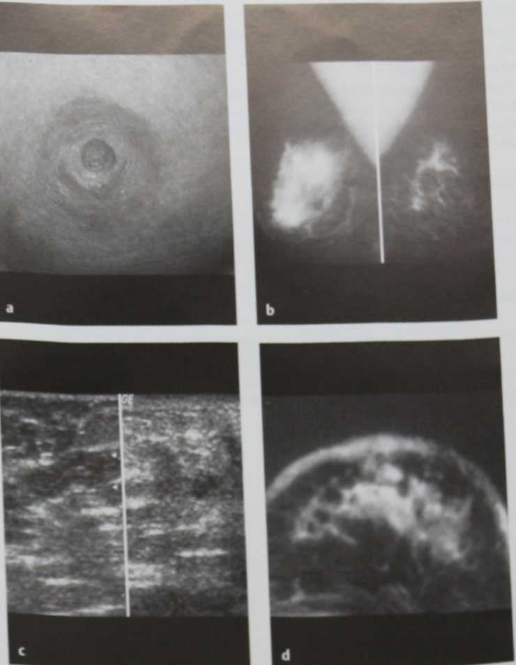 Снимки МРТ и КТ. Воспалительный рак молочной железы