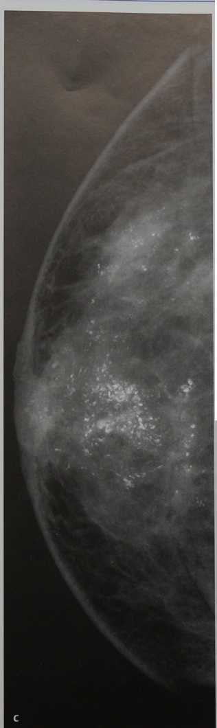 Снимки МРТ и КТ. Болезнь Педжета соска