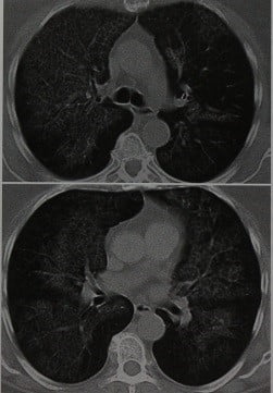 Снимки МРТ и КТ. Альвеолярный протеиноз