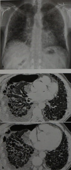 Снимки МРТ и КТ. Экзогенный аллергический альвеолит