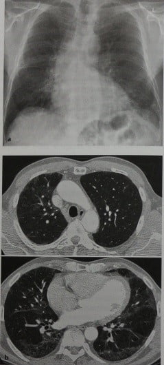 Снимки МРТ и КТ. Эозинофильная пневмония