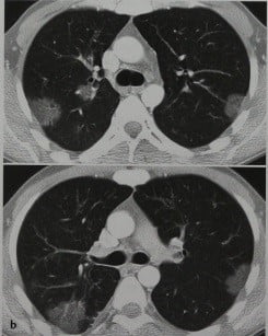 Снимки МРТ и КТ. Эозинофильная пневмония