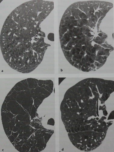 Снимки МРТ и КТ. Эмфизема легких