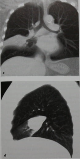 Снимки МРТ и КТ. Синдром средней доли