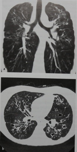 Снимки МРТ и КТ. Муковисцидоз (кистозный фиброз)
