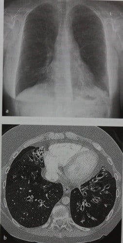 Снимки МРТ и КТ. Бронхоэктазы