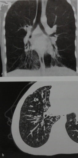 Снимки МРТ и КТ. Первичная цилиарная дискинезия,синдром Картагенера