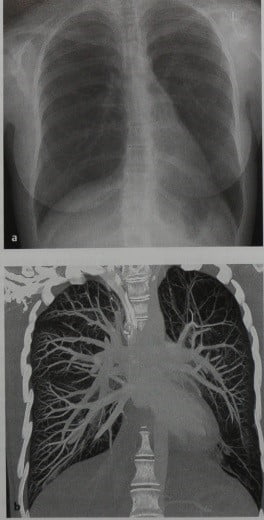 Снимки МРТ и КТ. Повышенная рентгенопрозрачность