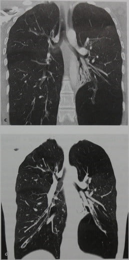 Снимки МРТ и КТ. Повышенная рентгенопрозрачность