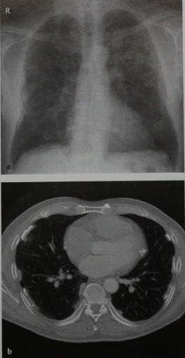 Снимки МРТ и КТ. Плевральные бляшки