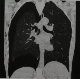 Снимки МРТ и КТ. Пневмоторакс: открытый, закрытый, клапанный