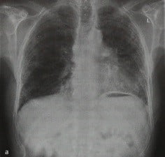 Снимки МРТ и КТ. Идиопатический фиброзирующий альвеолит