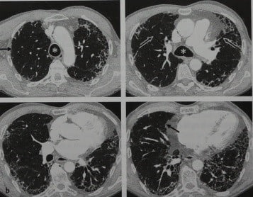 Снимки МРТ и КТ. Идиопатический фиброзирующий альвеолит