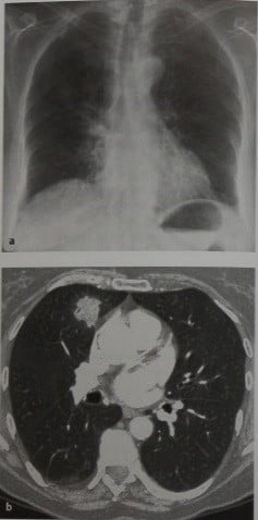 Снимки МРТ и КТ. Криптогенная организующаяся пневмония