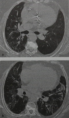 Снимки МРТ и КТ. Десквамативная интерстициальная пневмония