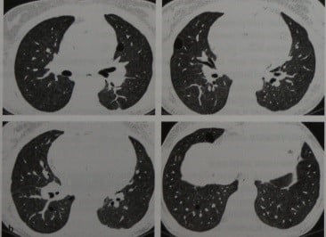 Снимки МРТ и КТ. Лимфоцитарный интерстициальный пневмонит
