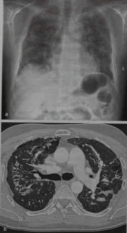 Снимки МРТ и КТ. Неспецифический интерстициальный пневмонит