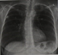 Снимки МРТ и КТ. Туберкулез легких