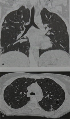 Снимки МРТ и КТ. Стафилококковая пневмония