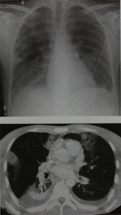 Снимки МРТ и КТ. Септическая эмболия