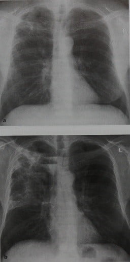 Снимки МРТ и КТ. Оппортунистическая пневмония