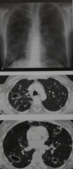 Снимки МРТ и КТ. Нетуберкулезная микобактериальная инфекция