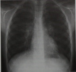 Снимки МРТ и КТ. Микоплазменная пневмония