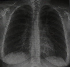 Снимки МРТ и КТ. Микоплазменная пневмония