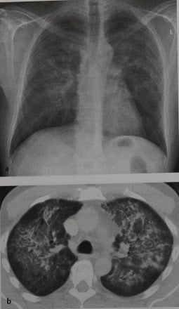 Снимки МРТ и КТ. Интерстициальная и атипичная пневмония