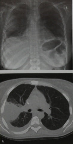 Снимки МРТ и КТ. Инвазивный легочный аспергиллез