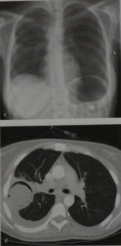 Снимки МРТ и КТ. Инвазивный легочный аспергиллез