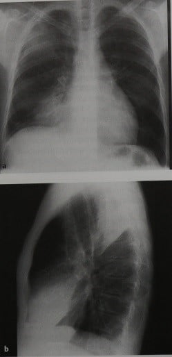 Снимки МРТ и КТ. Долевая пневмония