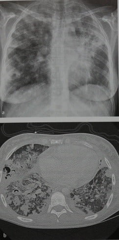 Снимки МРТ и КТ. Грибковая пневмония