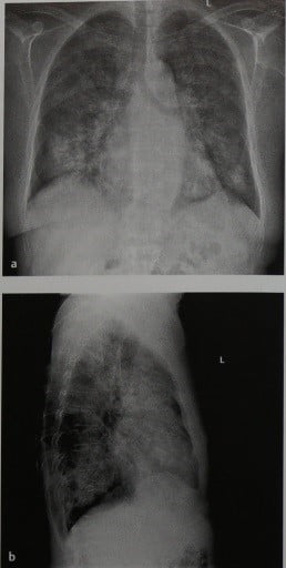 Снимки МРТ и КТ. Госпитальная (нозокомиальная) пневмония