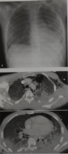 Снимки МРТ и КТ. Вирусная пневмония