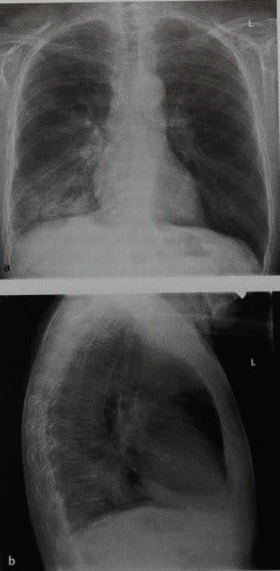 Снимки МРТ и КТ. Бытовая (негоспитальная) пневмония