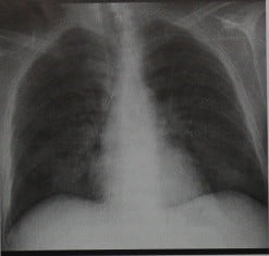 Снимки МРТ и КТ. Цитомегаловирусная пневмония