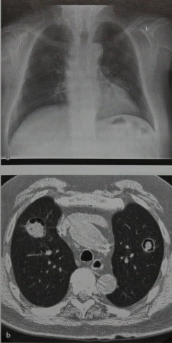 Снимки МРТ и КТ. Аспергиллема (неинвазивный аспергиллез)