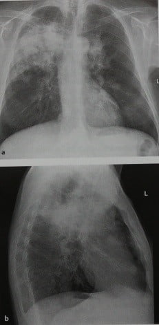 Снимки МРТ и КТ. Гранулематоз Вегенера грудная клетка