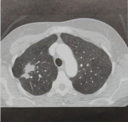 Снимки МРТ и КТ. Немелкоклеточный рак легкого
