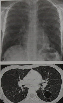 Снимки МРТ и КТ. Папилломатоз гортани