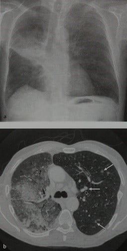Снимки МРТ и КТ. Бронхиолоальвеолярный (альвеолярно-клеточный) ра