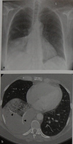 Снимки МРТ и КТ. Бронхиолоальвеолярный (альвеолярно-клеточный) ра