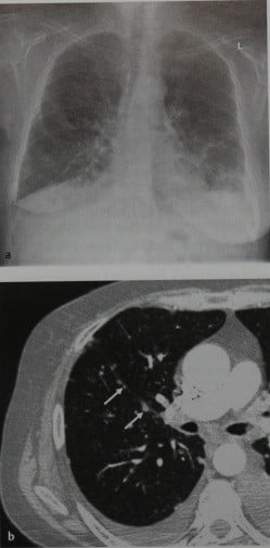 Снимки МРТ и КТ. Раковый лимфангиит