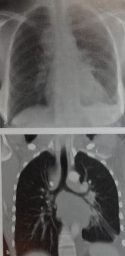 Снимки МРТ и КТ. Мелкоклеточный рак легкого