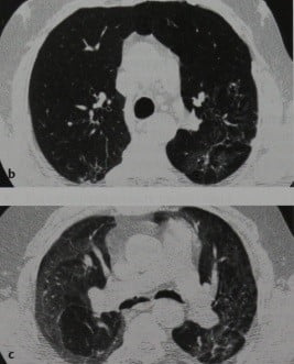 Снимки МРТ и КТ. Синдром облитерирующего бронхиолита