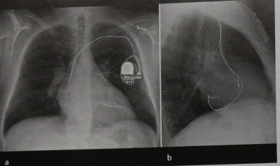 Снимки МРТ и КТ. Имплантированный электрокардиостимулятор