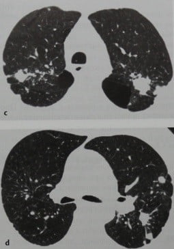 Снимки МРТ и КТ. Пневмокониоз